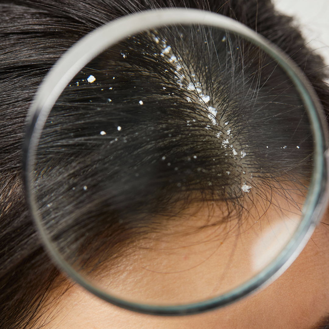 Hair Dandruff Treatment